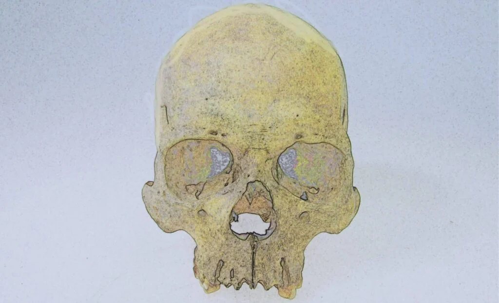 Ancient leprosy strain found in Chile